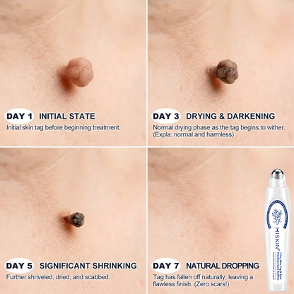 𝐇𝐈𝐒𝐊𝐈𝐍®💎 𝟕-𝐃𝒂𝘆 𝐒𝗸𝐢𝐧 𝐓𝒂𝗴 & 𝐒𝐩𝙤𝐭 𝐄𝐫𝒂𝐬𝙚𝐫 Painless & Scar-Free Advanced Imperfection Removal Rollerball Pen