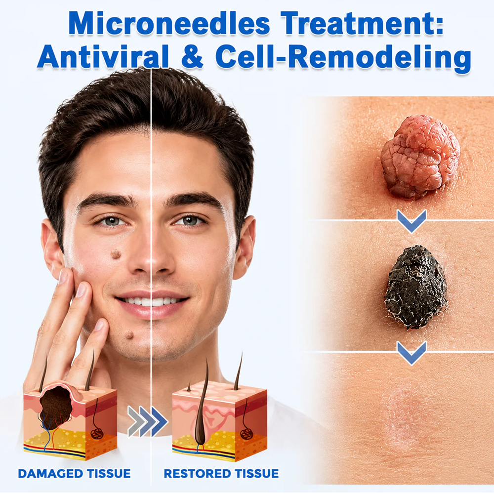 ✨✨Hiskin ® 2-in-1 Microneedle & Hydrocolloid Patch🍀 | Removes raised moles, acne, flat warts, and skin tags | Helps improve wrinkles, scars, and blemishes | Invisible patches for face and body