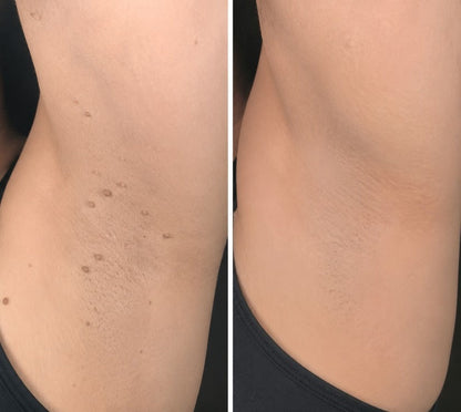 ✨✨Hiskin ® 2-in-1 Microneedle & Hydrocolloid Patch🍀 | Removes raised moles, acne, flat warts, and skin tags | Helps improve wrinkles, scars, and blemishes | Invisible patches for face and body