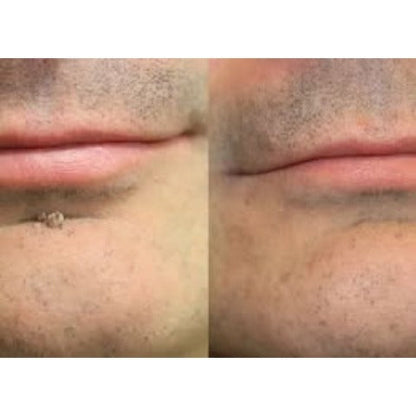 ✨✨Hiskin ® 2-in-1 Microneedle & Hydrocolloid Patch🍀 | Removes raised moles, acne, flat warts, and skin tags | Helps improve wrinkles, scars, and blemishes | Invisible patches for face and body