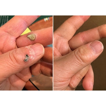 ✨✨Hiskin ® 2-in-1 Microneedle & Hydrocolloid Patch🍀 | Removes raised moles, acne, flat warts, and skin tags | Helps improve wrinkles, scars, and blemishes | Invisible patches for face and body