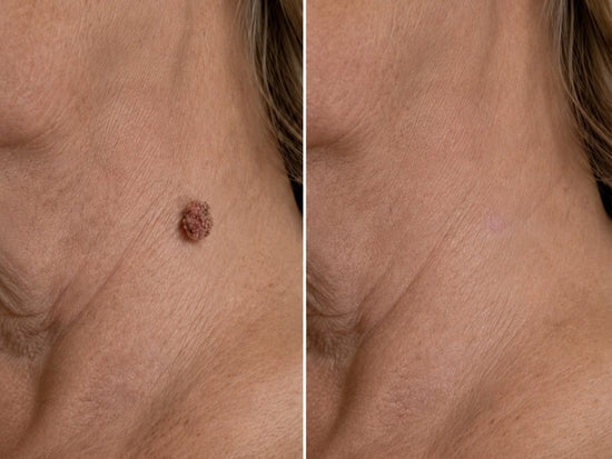 ✨✨Hiskin ® 2-in-1 Microneedle & Hydrocolloid Patch🍀 | Removes raised moles, acne, flat warts, and skin tags | Helps improve wrinkles, scars, and blemishes | Invisible patches for face and body