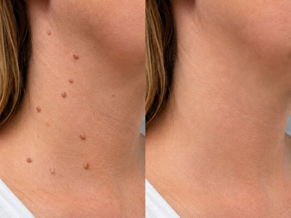✨✨Hiskin ® 2-in-1 Microneedle & Hydrocolloid Patch🍀 | Removes raised moles, acne, flat warts, and skin tags | Helps improve wrinkles, scars, and blemishes | Invisible patches for face and body