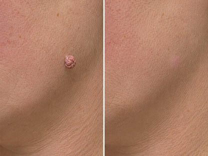 ✨✨Hiskin ® 2-in-1 Microneedle & Hydrocolloid Patch🍀 | Removes raised moles, acne, flat warts, and skin tags | Helps improve wrinkles, scars, and blemishes | Invisible patches for face and body